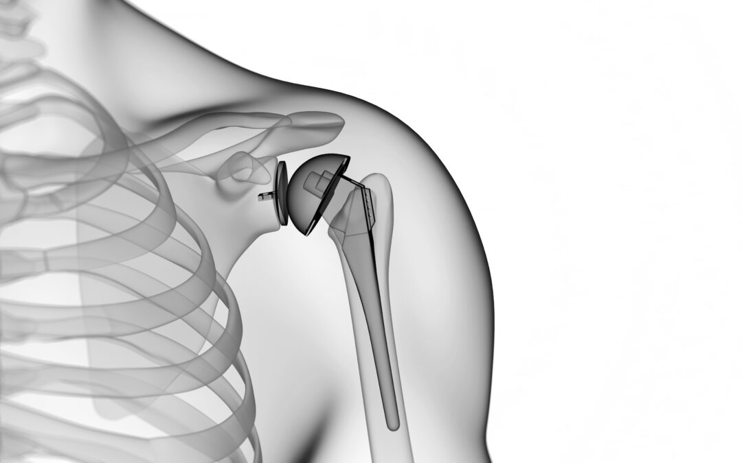 Case Study: Protesi di spalla inversa